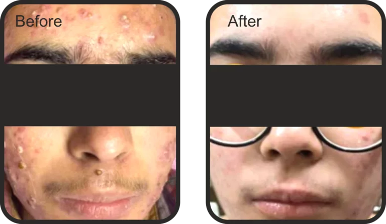 BLACK PEEL Exo Resurfacing- 10 ML