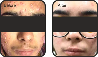 BLACK PEEL Exo Resurfacing- 10 ML