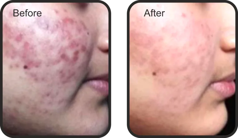 BLACK PEEL Exo Resurfacing- 10 ML