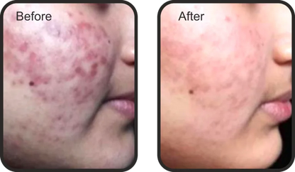 BLACK PEEL Exo Resurfacing- 10 ML