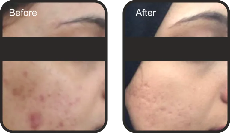 BLACK PEEL Exo Resurfacing- 10 ML