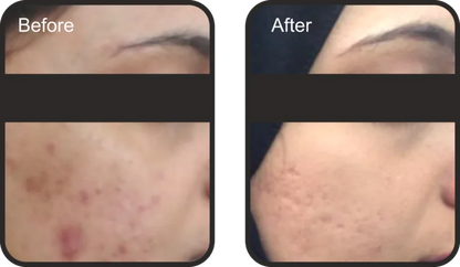 BLACK PEEL Exo Resurfacing- 10 ML