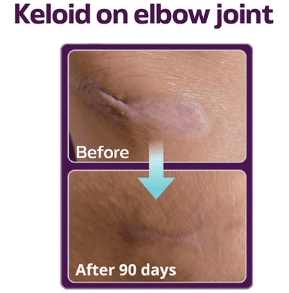 Anscare Leniscar Silicone Stick with Vitamin C & E